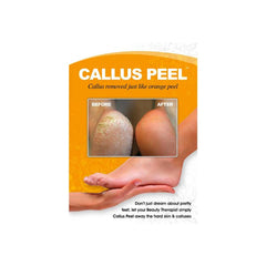 Callus Peel A3 Poster